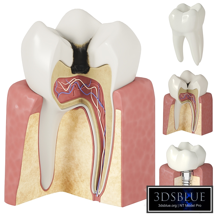Stages of dental caries and dental implant